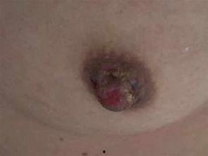 湿疹吃茭瓜好吗,湿疹患者适宜食用茭瓜吗？