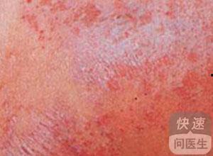 湿疹吃茭瓜好吗,湿疹患者适宜食用茭瓜吗？